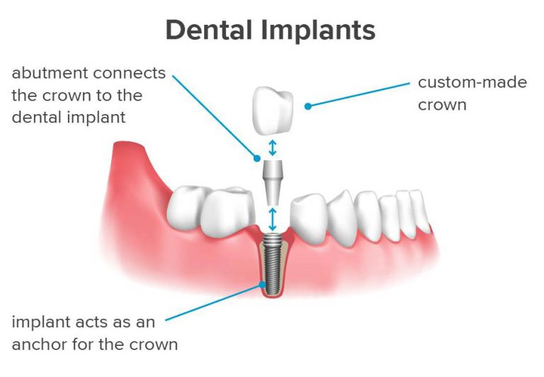 How To Ensure That Dental Visits Are Safe During The New Coronavirus Period?